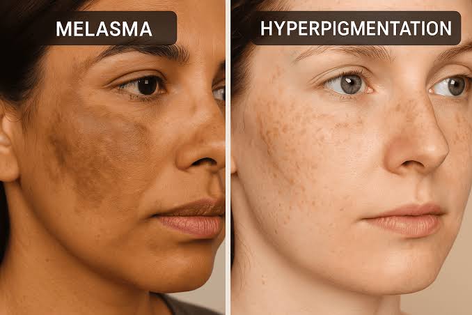 PIGMENTATION (MELASMA) - त्वचेवरील काळे डाग / मेलाझ्मा